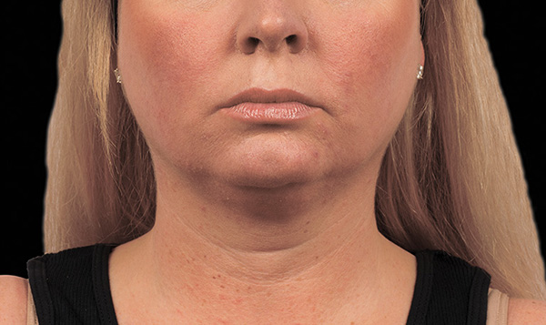 double chin reduction treatment coolsculpting Larchmont
